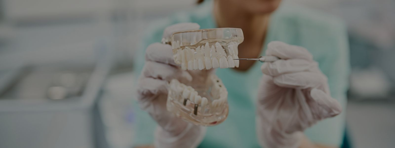 Beneficios para la salud de los implantes dentales